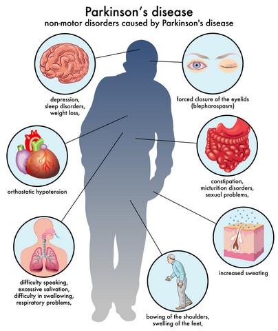 What Is Parkinson's Disease?